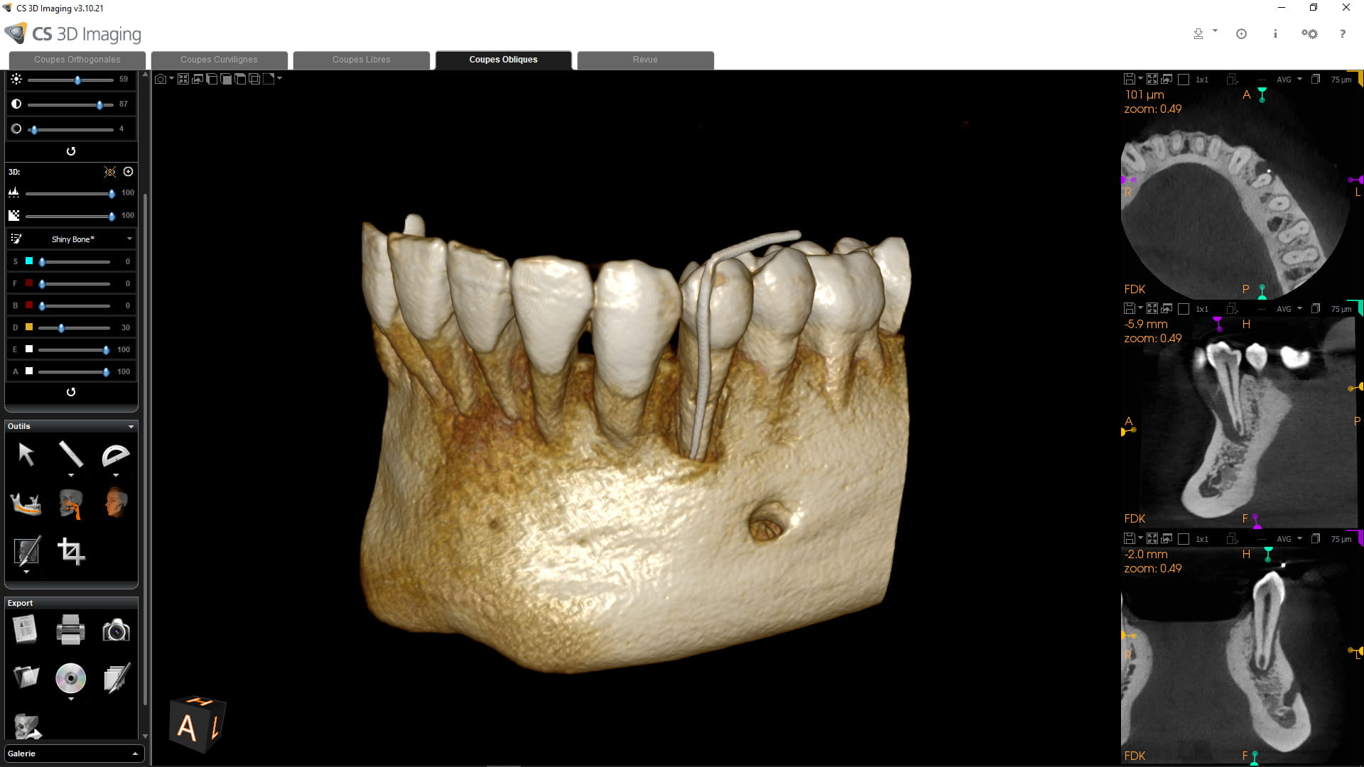 CS 8200 3D 5×5 cm intern resorption